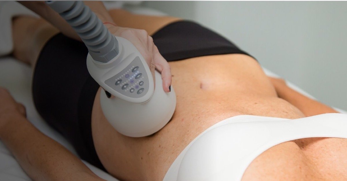 Aplicación de cabezal Venus Legacy en zona abdominal