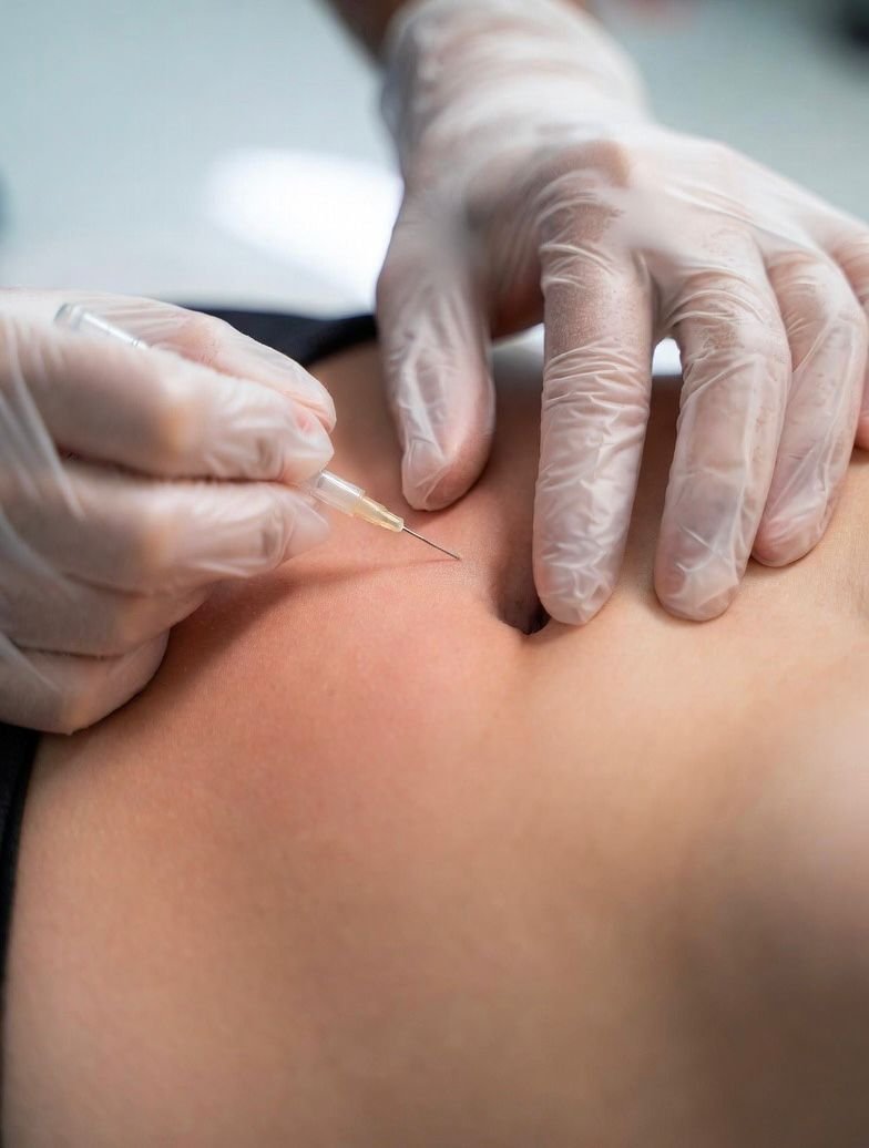 Carboxiterapia